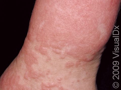 This image displays typical pink to red elevations of the skin and non-scaling, slightly elevated lesions on a patient with a viral exanthem.