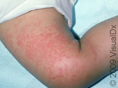 Viral exanthem is the term for the red bumps and flat lesions seen in many viral infections.