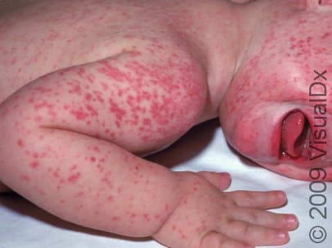 Viral exanthems can have intense red, inflamed skin lesions.