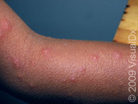 This image displays how some lesions from viral exanthem may develop into blisters.