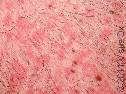 As displayed in this image, the pink to red elevations of the skin from viral exanthem are not scaly.