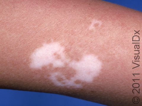 This image displays areas of complete absence of skin pigment typical of vitiligo.