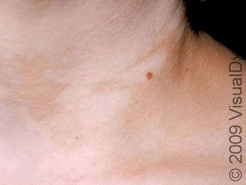 In fair skin patients, vitiligo can be subtle. The total loss of pigment cells make these patients high risk for sunburn within the affected areas.
