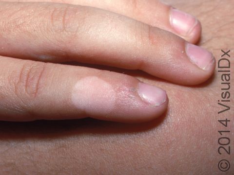 The fingers are a frequent skin location for patches of vitiligo.