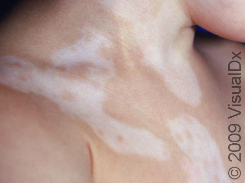 This image displays islands of normal skin within the white skin affected by vitiligo.