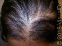 Preparing for Your Dermatologist Visit: Hair Loss Basics