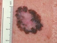 Melanoma or Mole? Learn to Recognize the Difference