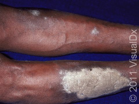 This image displays psoriasis, which can develop a thick, white scale.