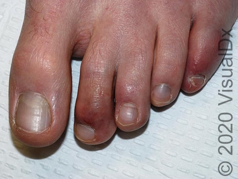 Red-purple discoloration of toes with swelling.