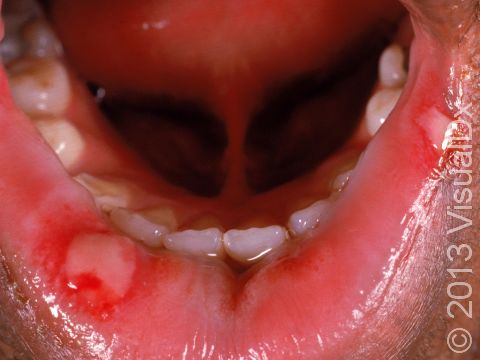 This canker sore (aphthous ulcer) has a typical red border and white center.