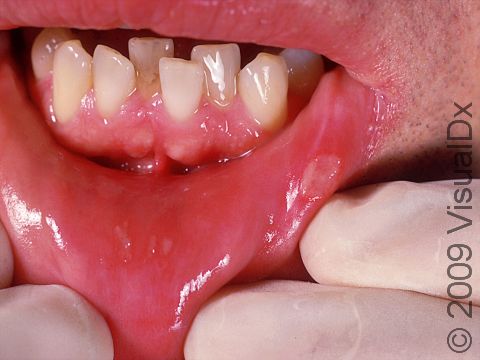This image displays white-to-yellow lesions typical of aphthous ulcers.