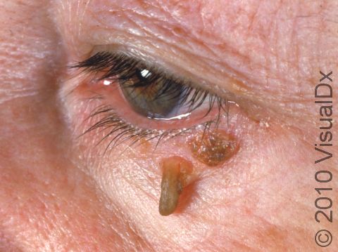 Warts on the face can cause thick scaling.