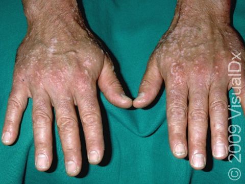 This image displays a severe case of flat warts on the hands, including dozens of white-appearing lesions.