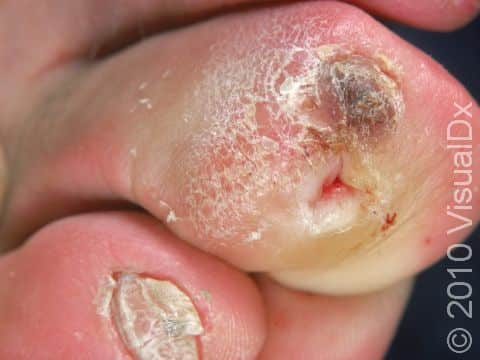 The toes can also be affected by neurogenic ulceration; the dark color is due to bleeding into the area of pressure and callus.