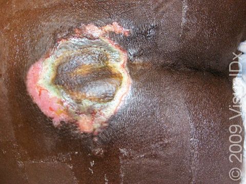 A pressure ulcer can be seen in the area just above the buttock crease.
