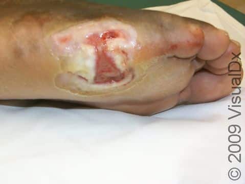 This ulcer on the side of the foot is from prolonged pressure.