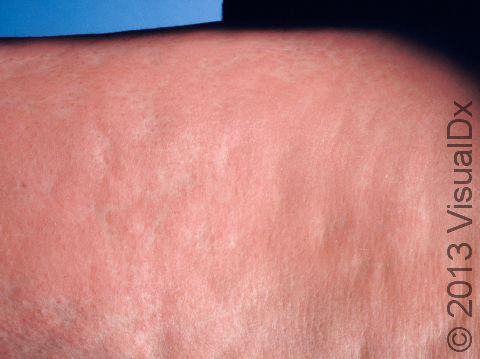This image displays urticaria (hives) with significant swelling in the skin tissue and some normal areas of skin, which look dimpled or depressed within the lesion.