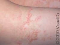Dry Skin (Xerosis)