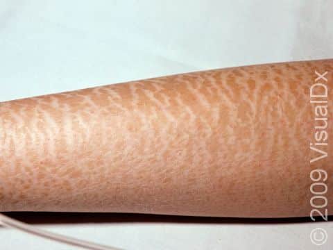 This image displays an extreme case of xerosis (dry skin).
