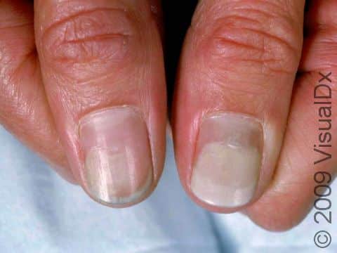 Onycholysis has many causes, including psoriasis, fungal nail infection, or a reaction to a medication.