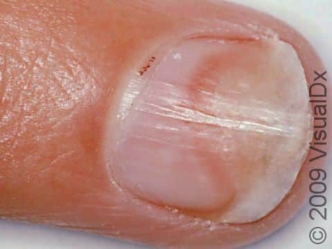 Onycholysis of the nails - what is it, what are the causes, and how to ...