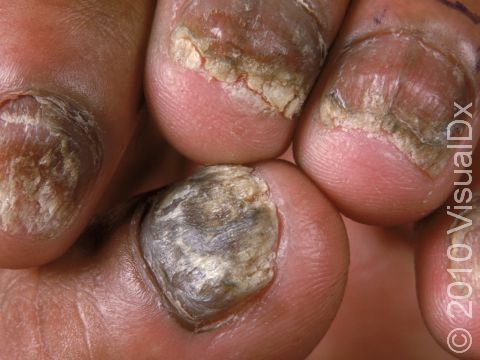 This image displays the fungal infection onychomycosis.