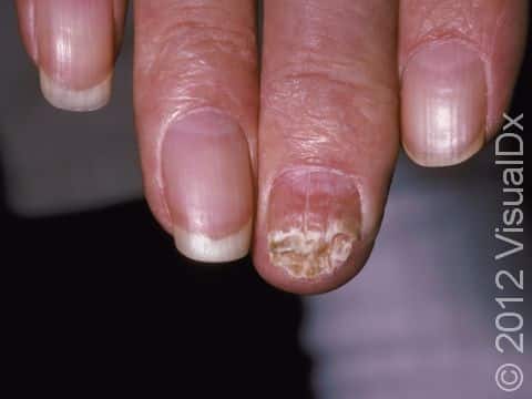 In onychomycosis, a fungal nail infection, the nail typically lifts and is brittle. There may be scaly debris below the nail.