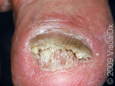 This image displays a nail bed with scaling and debris caused by the lifting of the nail plate in onycholysis.