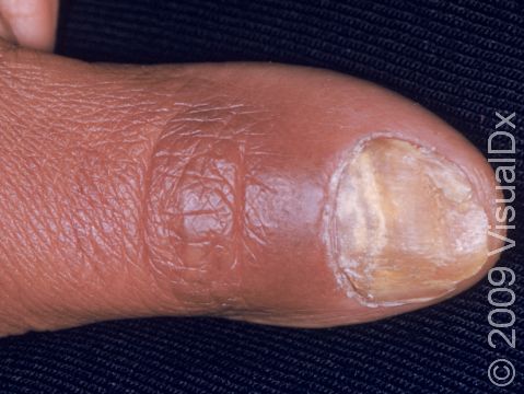 This image displays onychomycosis, a nail fungus infection.