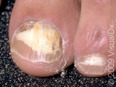 White nails accompanied by slightly elevated lesions are typical of onychomycosis (fungal nail infections).