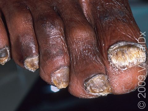 This image displays a thickening of the nails and accumulation of scaly debris below the nail typical of onychomycosis (a fungal infection of the nails).