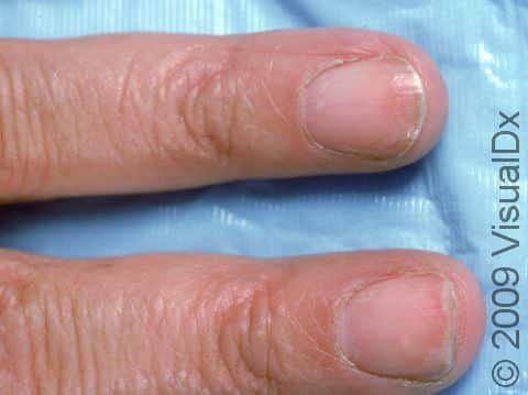 Onychoschizia means plate-like splitting of the free edge of the nail.