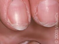 Nail Splitting (Onychoschizia)