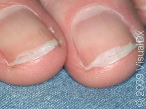 Onychoschizia is most often caused by repeated wetting and drying of the nails.