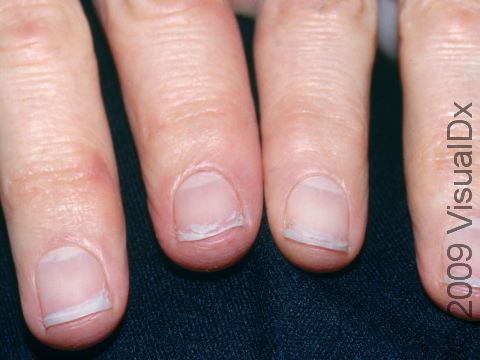 Brittle Nail Syndrome Causes, Signs & Symptoms, Diagnosis, brittle nails