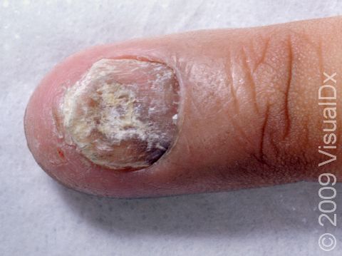 This image displays a rough, distorted nail due to chronic inflammation in the skin around the nail, known as paronychia.