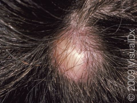 This image displays a hard, skin-colored cyst on the scalp.