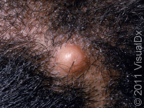 Pilar cysts originate from the hair pore; they are very firm to hard.