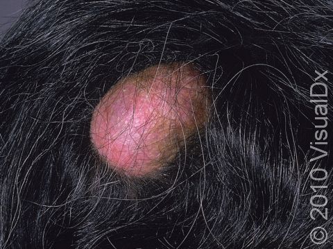 A pilar cyst is a benign cyst that must be surgically removed.