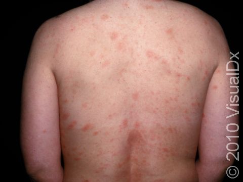 The dull pink patches of pityriasis rosea typically involve the trunk.