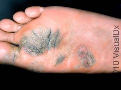 Plantar warts can look like giant calloses, as displayed in this image.