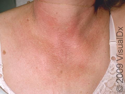 Poikiloderma of Civatte typically occurs on the neck and, in a v-shaped distribution, on the upper chest that includes redness and a 