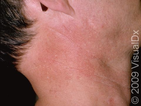 As displayed in this image, Poikiloderma of Civatte is displayed as redness on the neck and the 