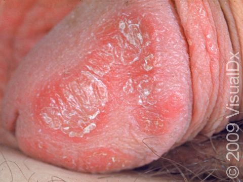 This image displays the scaly redness of the skin typical of psoriasis.
