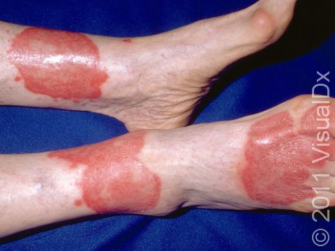 Psoriasis can be slightly scaly with bright red, well-demarcated areas.