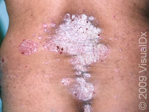This image displays scaly, slightly elevated lesions on the lower back and buttocks, typical locations for psoriasis.