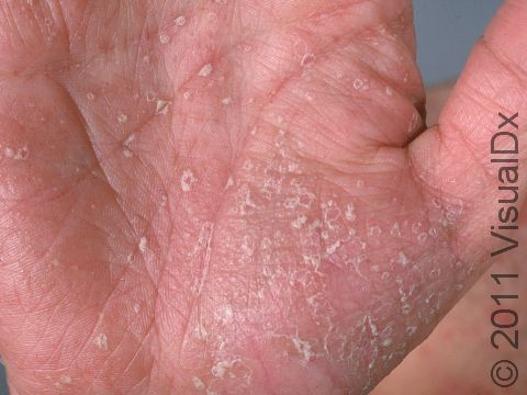 This image displays minimal scale with subtle redness due to psoriasis.