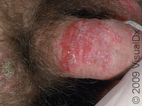 This image displays redness and scaly skin due to psoriasis.