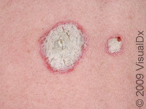 This image displays thick, white, scaly skin with redness underneath, typical of psoriasis.