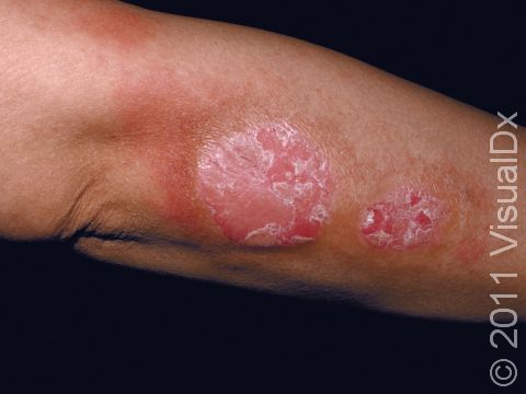 Dermatofibroma – Adult